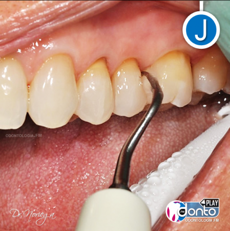 Limpieza dental con ultrasonido